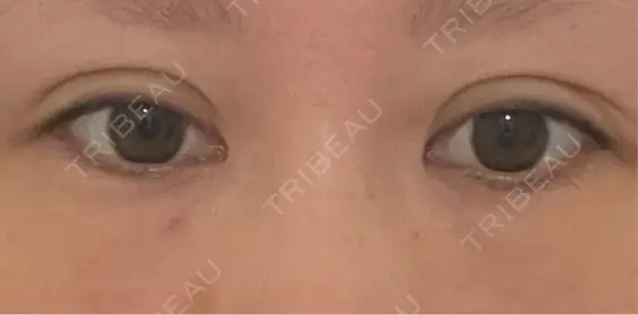 クマ治療 / 下まぶたの脂肪取り / ヒアルロン酸注入（目の下） ROOTS Clinic BEFORE メイン用