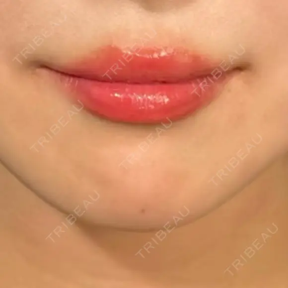 ヒアルロン酸注入（涙袋） / ヒアルロン酸注入（唇） 東京シンデレラ美容外科 大宮院 BEFORE メイン用