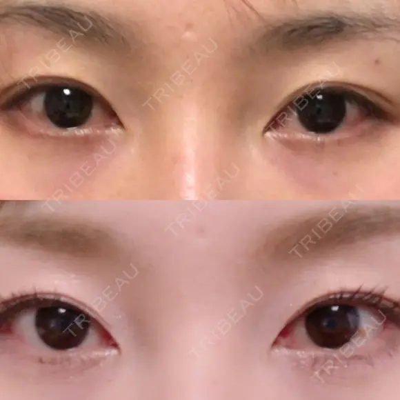 二重切開 / 眼瞼下垂（切開） / 上まぶたたるみ取り 湘南美容クリニック 新宿南口院 BEFORE メイン用