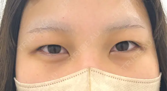 二重埋没 / ヒアルロン酸注入（涙袋） BELINDA CLINIC（ベリンダクリニック）新宿院 BEFORE メイン用