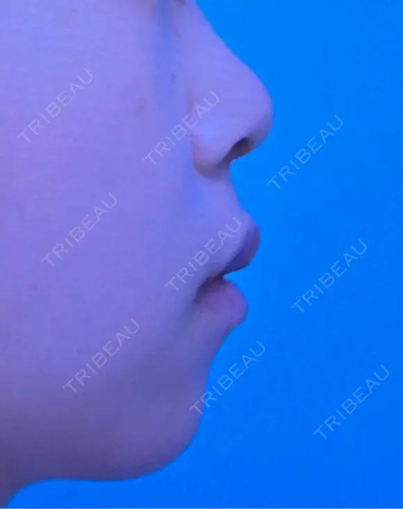 ヒアルロン酸注入（あご） ヴェリテクリニック 大阪院 BEFORE メイン用