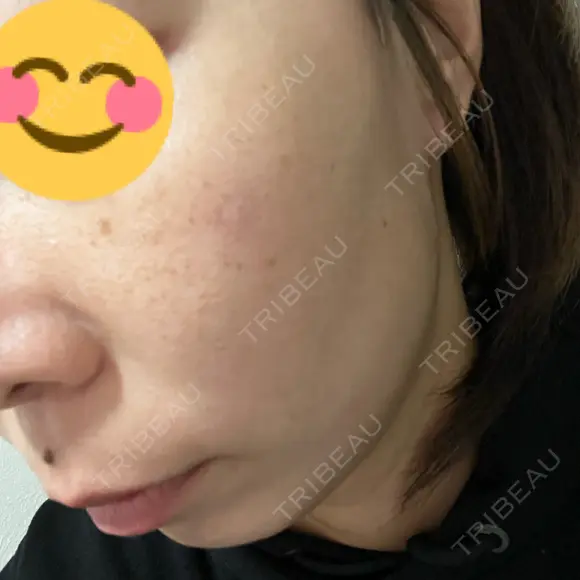 ルメッカ Belle Via Skin Clinic BEFORE メイン用