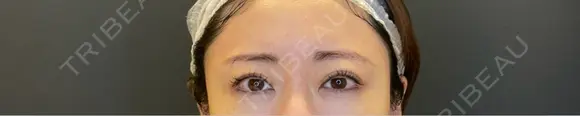 二重埋没 / タレ目形成・グラマラスライン（埋没） LOUIS CLINIC 二子玉川院【ルイクリニック】 BEFORE メイン用