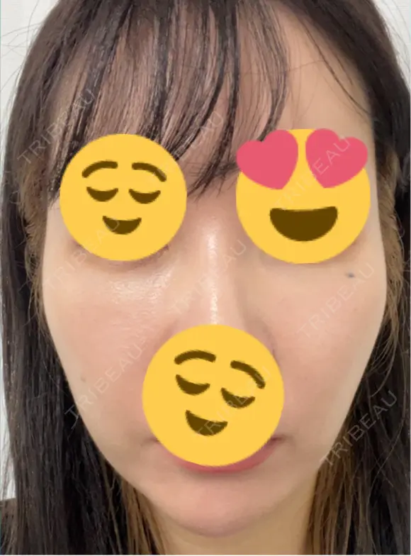 その他（輪郭） ARTE BEAUTY CLINIC BEFORE メイン用