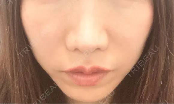 ヒアルロン酸注入（唇） / ボトックス（口角） おおたかの森ビューティークリニック BEFORE メイン用