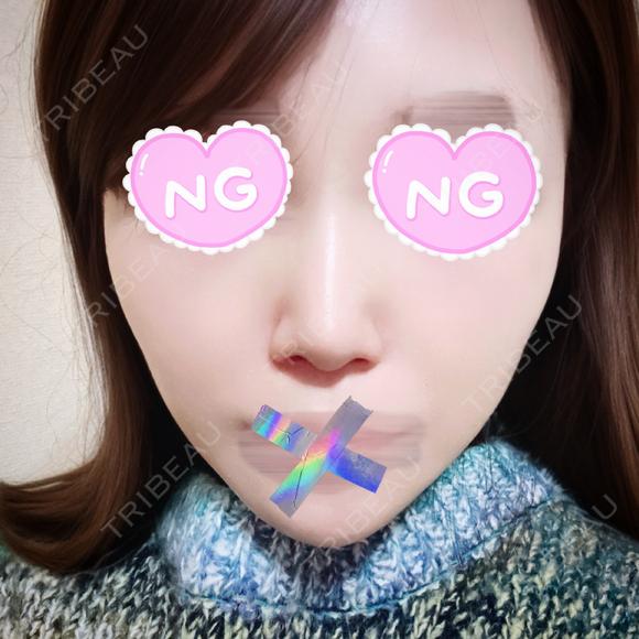 ヒアルロン酸注入（鼻翼基部） / ヒアルロン酸注入（ほうれい線） 銀座美容外科クリニック 新宿院 BEFORE メイン用