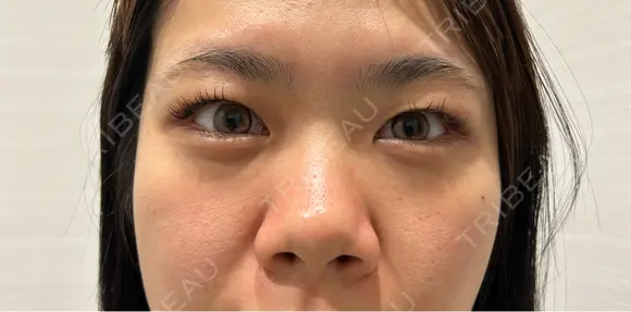 二重埋没 / 隆鼻術 / 鼻尖形成（切開） / 小鼻縮小（切開） / 軟骨移植 R Beauty CLINIC 名古屋院 BEFORE メイン用