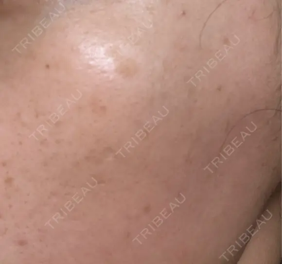 ルメッカ B-LINE CLINIC 池袋院 BEFORE メイン用