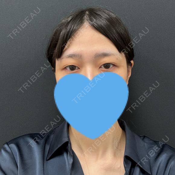 二重埋没 / クマ治療 湘南美容クリニック 西葛西院 BEFORE メイン用