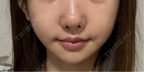 ボトックス（エラ・小顔） L‘amour clinic Tokyo【ラムールクリニック東京】 BEFORE メイン用