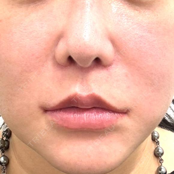 脂肪溶解注射（顔） WellnessPlus Clinic 【ウェルネスプラスクリニック】 BEFORE メイン用