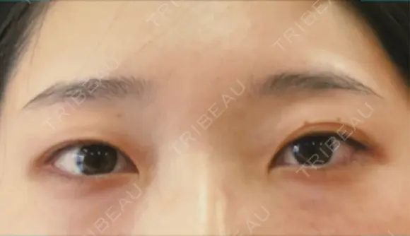 二重埋没 宇都宮竹内クリニック BEFORE メイン用