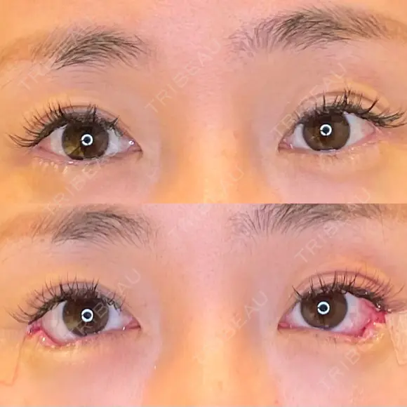 目尻切開 / タレ目形成・グラマラスライン（埋没） LOUIS CLINIC 二子玉川院【ルイクリニック】 BEFORE メイン用