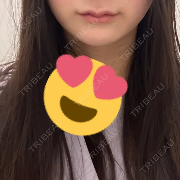 ヒアルロン酸注入（唇） / ヒアルロン酸注入（鼻翼基部） 銀座美容外科クリニック 新宿院 BEFORE メイン用