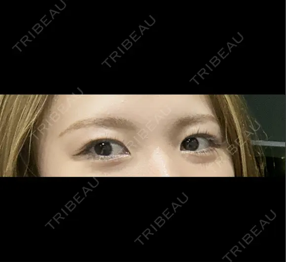 二重埋没 湘南美容クリニック 静岡院 BEFORE メイン用