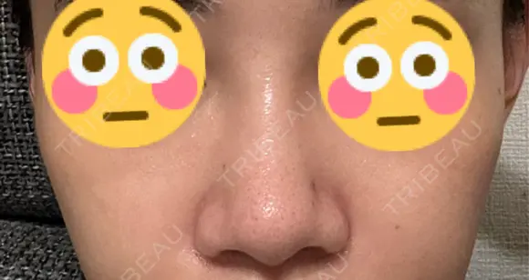 鼻尖形成（切開） / 鼻尖縮小 / 小鼻縮小（非切開） 銀座マイアミ美容外科 BEFORE メイン用
