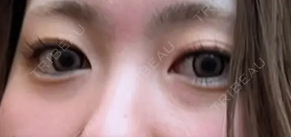 二重切開 / 目頭切開 / クマ治療 / 目尻切開 EMMA CLINIC（エマクリニック） BEFORE メイン用