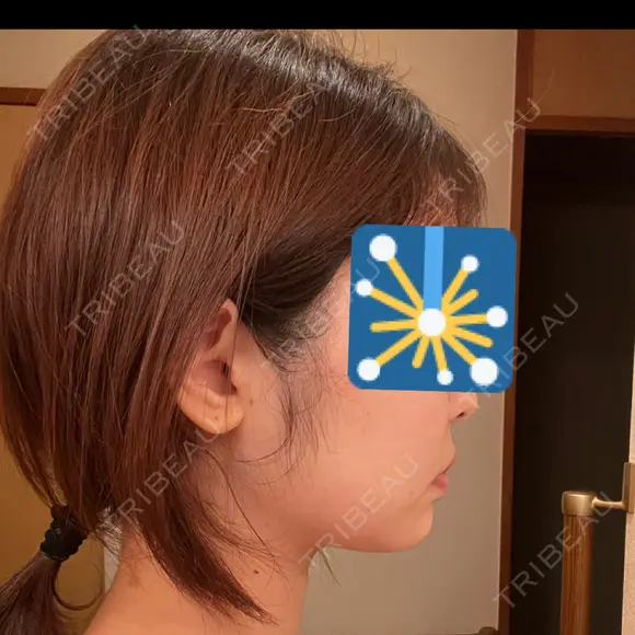 ジョールファット除去 / 脂肪吸引注射（顔） 湘南美容クリニック 大阪梅田本院 BEFORE メイン用