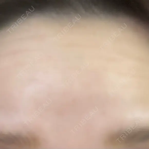 ボトックス（額） / その他（鼻） TCB東京中央美容外科 盛岡院 BEFORE メイン用