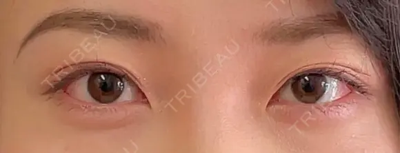 二重埋没 湘南美容クリニック 西葛西院 BEFORE メイン用