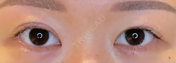 目尻切開 / タレ目形成・グラマラスライン（埋没） LOUIS CLINIC 二子玉川院【ルイクリニック】 BEFORE メイン用