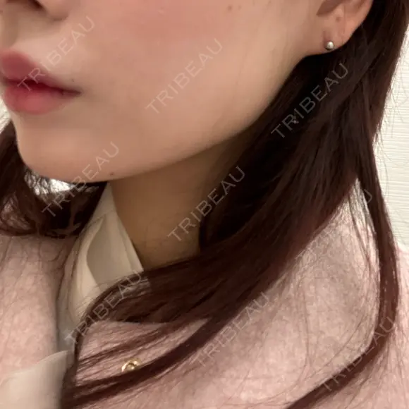 ボトックス（エラ・小顔） 川越TAクリニックアソシエ BEFORE メイン用