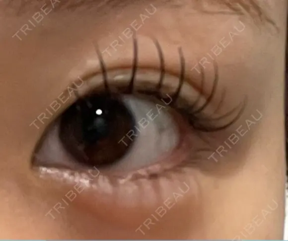 目頭切開 9BeautyClinic BEFORE メイン用