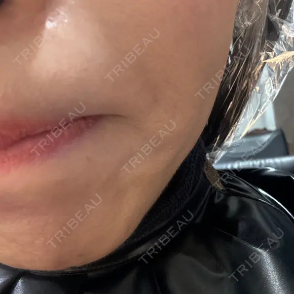 スネコス 美容皮膚科エルムクリニック 大阪院 BEFORE メイン用