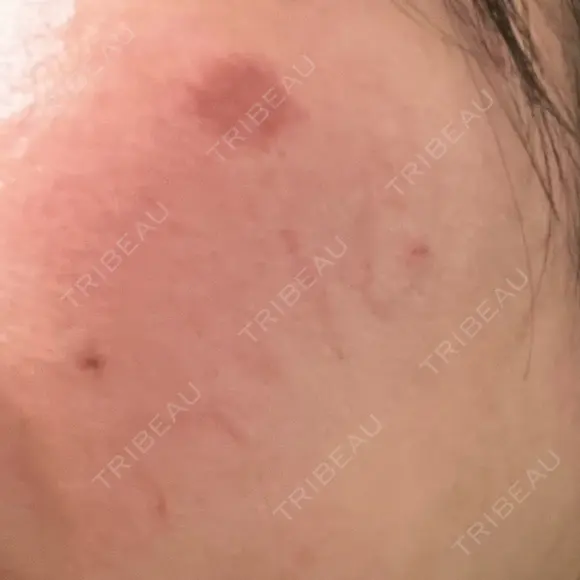 シミ取りレーザー / エレクトロポレーション / 毛穴洗浄（ハイドラフェイシャルなど） まゆりなclinic 名古屋栄 BEFORE メイン用