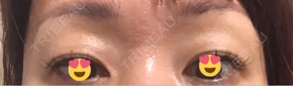 眉下切開 銀座リシェスクリニック BEFORE メイン用