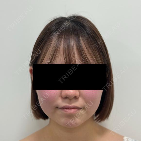 脂肪吸引（顔） / 脂肪吸引注射（顔） SEA CLINIC（シークリニック） BEFORE メイン用