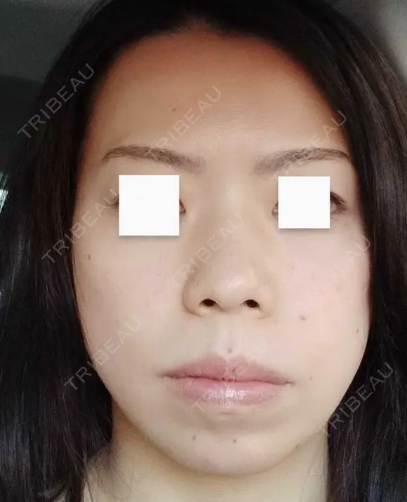 エレクトロポレーション / 毛穴洗浄（ハイドラフェイシャルなど） / 光治療（フォトフェイシャルなど） Leap beauty clinic BEFORE メイン用