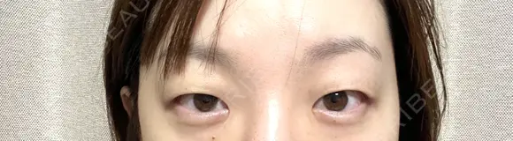 二重切開 / 目頭切開 / 上まぶたの脂肪取り / 眉下切開 タシピウム整形外科 BEFORE メイン用