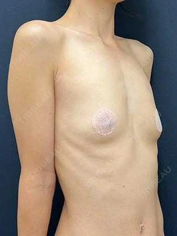 豊胸（脂肪注入） 湘南美容クリニック 吉祥寺院 BEFORE メイン用