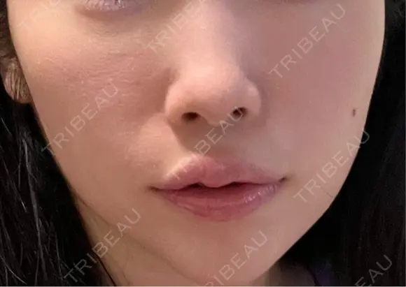 ヒアルロン酸注入（頬） 湘南美容クリニック 大阪梅田本院 BEFORE メイン用