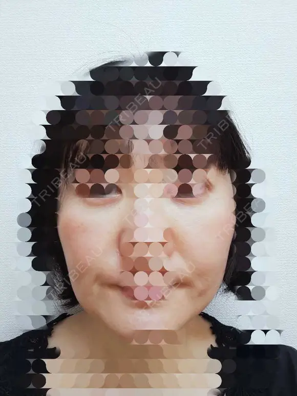 肌ヒアルロン酸注入（たるみ・シワ改善） / シワ取りボトックス 東京形成美容外科 船橋院 BEFORE メイン用