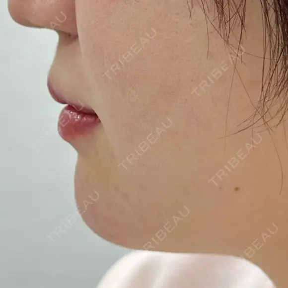 ヒアルロン酸注入（あご） / ヒアルロン酸注入（唇） PRO CLINIC プロクリニック 銀座院 BEFORE メイン用