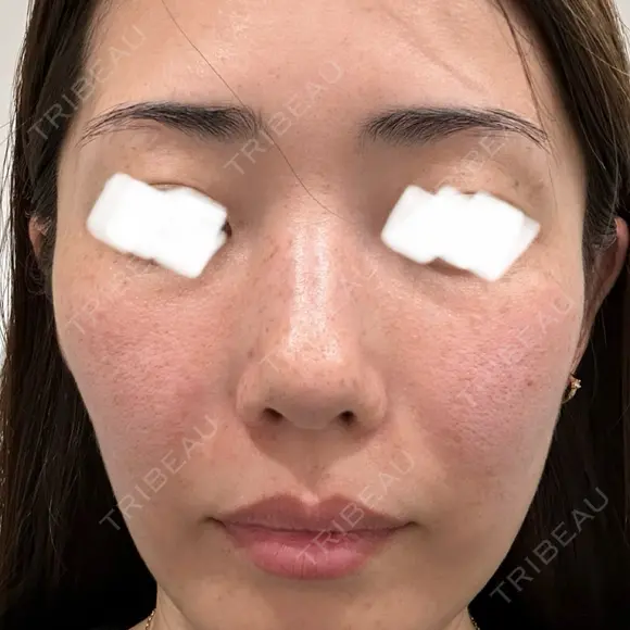 光治療（フォトフェイシャルなど） ミニマムスキンクリニック池袋 BEFORE メイン用