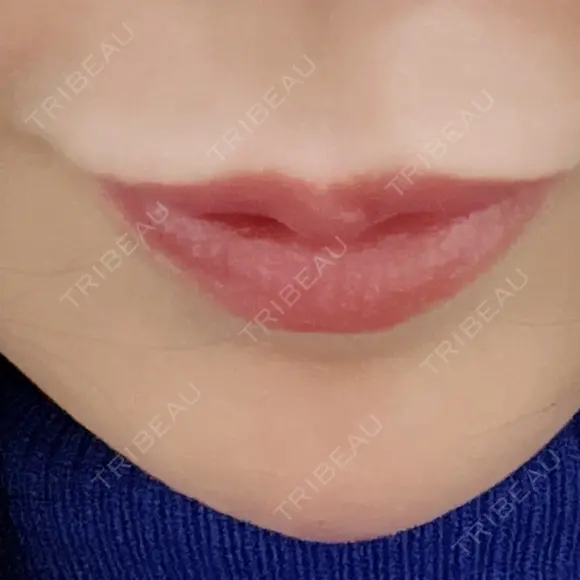 アートメイク（ほくろ） 新宿クレアクリニック BEFORE メイン用