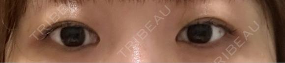 二重埋没 / 自然癒着法 Brandnew Beauty Clinic BEFORE メイン用