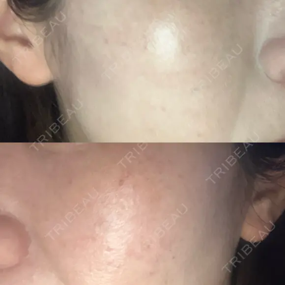 光治療（フォトフェイシャルなど） 小木曽クリニック BEFORE メイン用