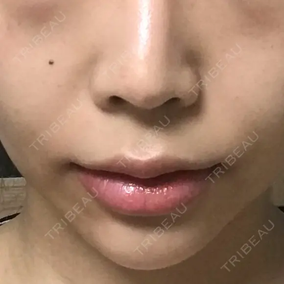 人中短縮 / 口角挙上 清潭女神美容外科 BEFORE メイン用