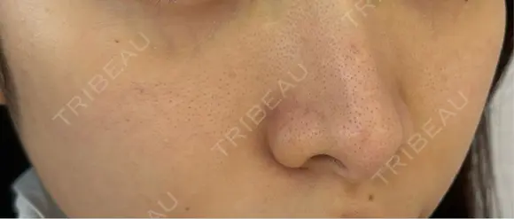 マイクロボトックス lime clinic （杏クリニック） BEFORE メイン用