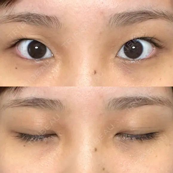 二重切開 / 目頭切開 オーキッド美容クリニック東京御徒町 BEFORE メイン用