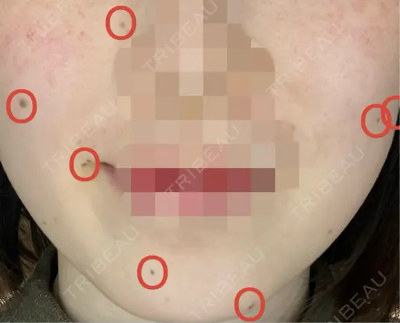 ほくろ・いぼ切除（肌） KARIS beauty clinic BEFORE メイン用