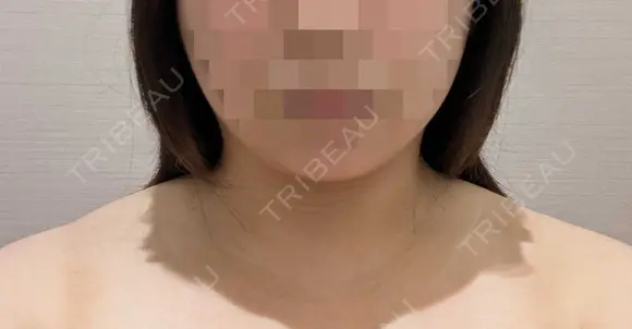 ボトックス（エラ・小顔） / 脂肪溶解注射（顔） おおたかの森ビューティークリニック BEFORE メイン用