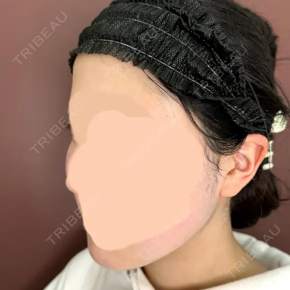 脂肪溶解注射（顔） 仙台N美容クリニック BEFORE メイン用