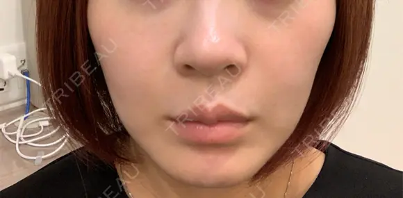 美容点滴・美容注射（美肌） / ヒアルロン酸注入（鼻翼基部） ヴェリテクリニック 大阪院 BEFORE メイン用