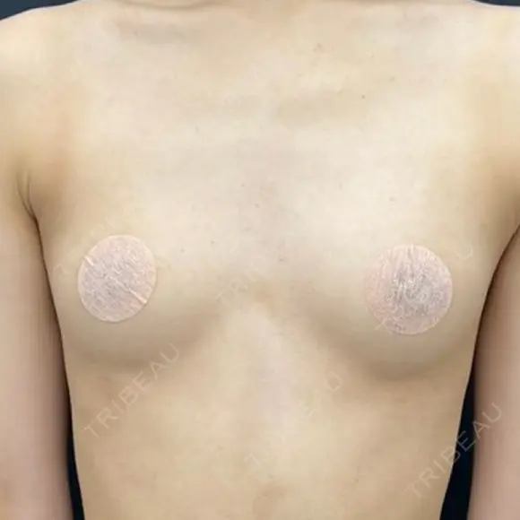 豊胸（脂肪注入） 湘南美容クリニック 吉祥寺院 BEFORE メイン用