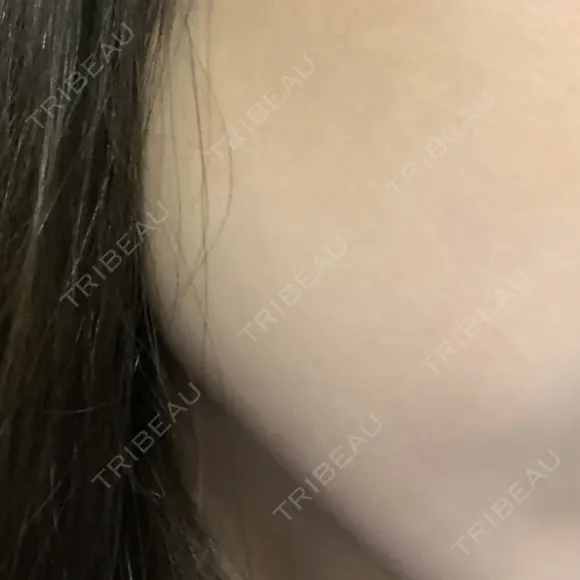 ピーリング（ニキビ・毛穴） 渋谷美容外科クリニック 横浜院 BEFORE メイン用